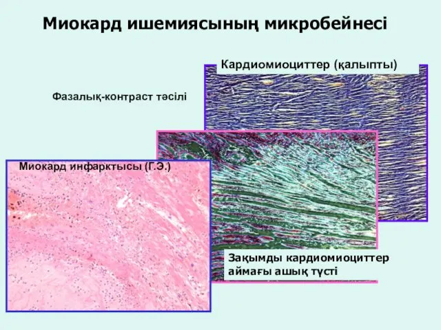 Миокард ишемиясының микробейнесі Зақымды кардиомиоциттер аймағы ашық түсті Кардиомиоциттер (қалыпты) Миокард инфарктысы (Г.Э.) Фазалық-контраст тәсілі