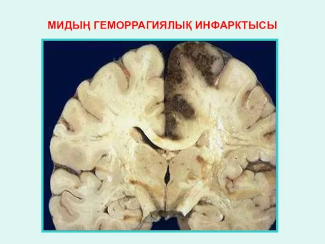 МИДЫҢ ГЕМОРРАГИЯЛЫҚ ИНФАРКТЫСЫ