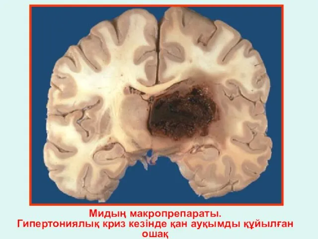 Мидың макропрепараты. Гипертониялық криз кезінде қан ауқымды құйылған ошақ