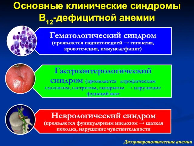 Основные клинические синдромы В12-дефицитной анемии Дизэритропоэтические анемии