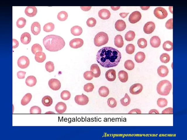 Дизэритропоэтические анемии