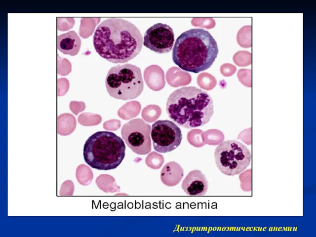 Дизэритропоэтические анемии