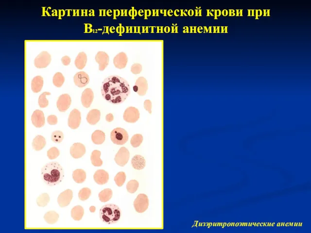 Картина периферической крови при В12-дефицитной анемии Дизэритропоэтические анемии