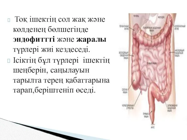 Тоқ ішектің сол жақ және көлденең бөлшегінде эндофиттті және жаралы