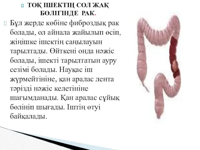 ТОҚ ІШЕКТІҢ СОЛ ЖАҚ БӨЛІГІНДЕ РАК. Бұл жерде көбіне фиброздық