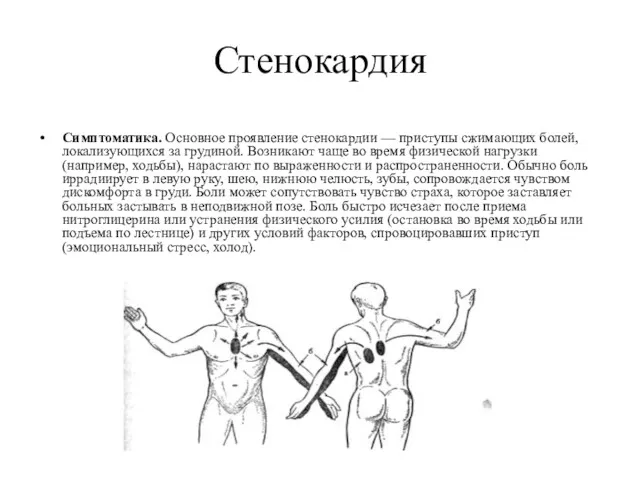 Стенокардия Симптоматика. Основное проявление стенокардии — приступы сжимающих болей, локализующихся за грудиной. Возникают