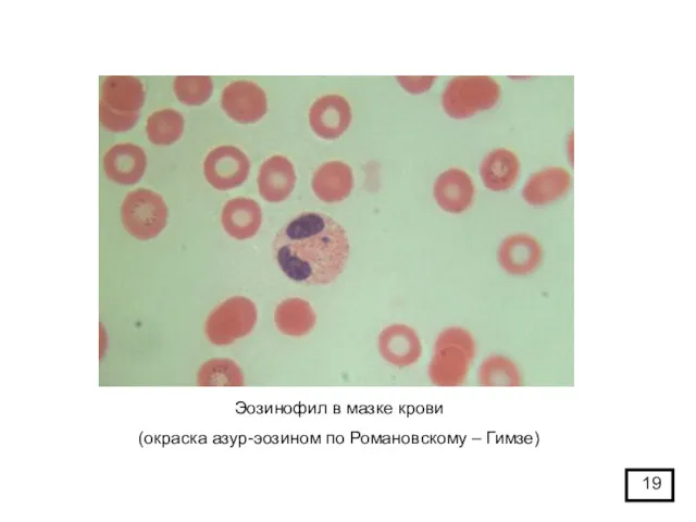 Эозинофил в мазке крови (окраска азур-эозином по Романовскому – Гимзе)