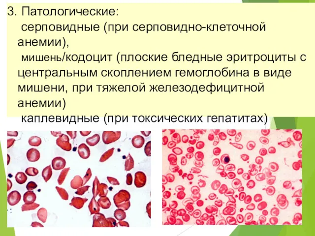 3. Патологические: серповидные (при серповидно-клеточной анемии), мишень/кодоцит (плоские бледные эритроциты с центральным скоплением
