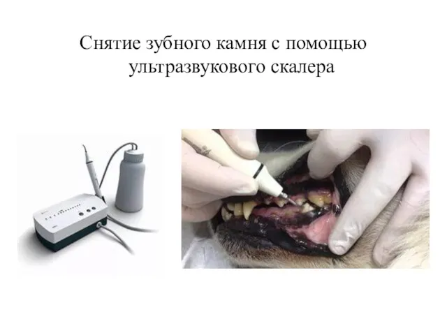 Снятие зубного камня с помощью ультразвукового скалера