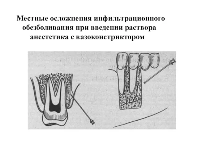 Местные осложнения инфильтрационного обезболивания при введении раствора анестетика с вазоконстриктором