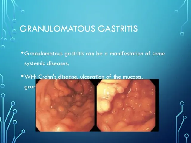 GRANULOMATOUS GASTRITIS Granulomatous gastritis can be a manifestation of some systemic diseases. With