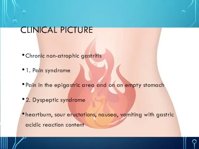 CLINICAL PICTURE Chronic non-atrophic gastritis 1. Pain syndrome Pain in the epigastric area
