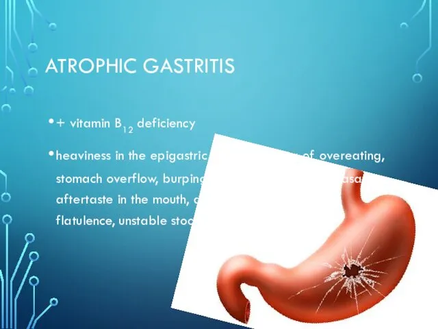 ATROPHIC GASTRITIS + vitamin B12 deficiency heaviness in the epigastric area, a feeling