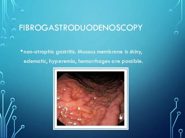 FIBROGASTRODUODENOSCOPY non-atrophic gastritis. Mucous membrane is shiny, edematic, hyperemia, hemorrhages are possible.