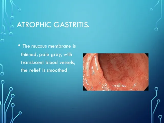 ATROPHIC GASTRITIS. The mucous membrane is thinned, pale gray, with translucent blood vessels,