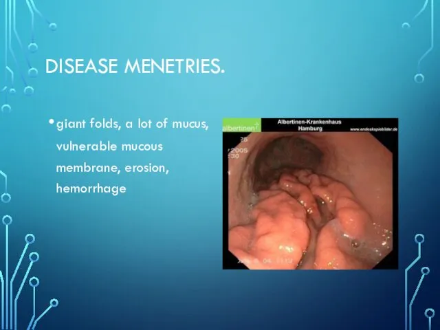 DISEASE MENETRIES. giant folds, a lot of mucus, vulnerable mucous membrane, erosion, hemorrhage