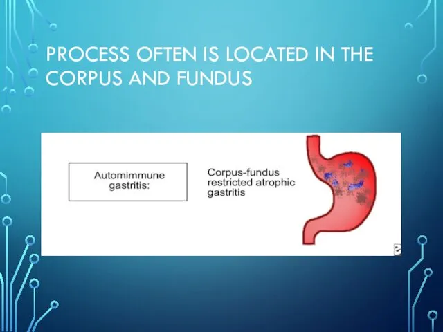 PROCESS OFTEN IS LOCATED IN THE CORPUS AND FUNDUS