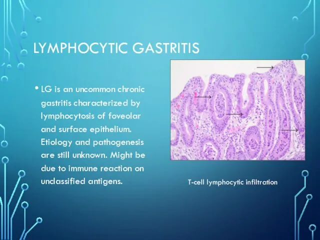 LYMPHOCYTIC GASTRITIS LG is an uncommon chronic gastritis characterized by lymphocytosis of foveolar