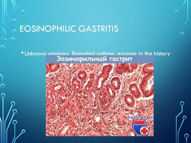 EOSINOPHILIC GASTRITIS Unknown etiology. Bronchial asthma, eczema in the history