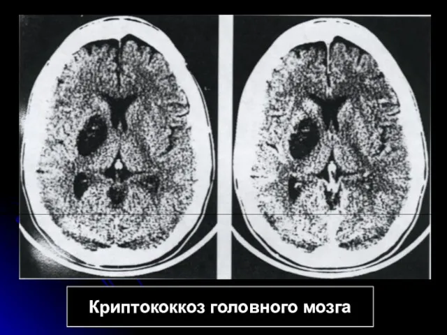 Криптококкоз головного мозга