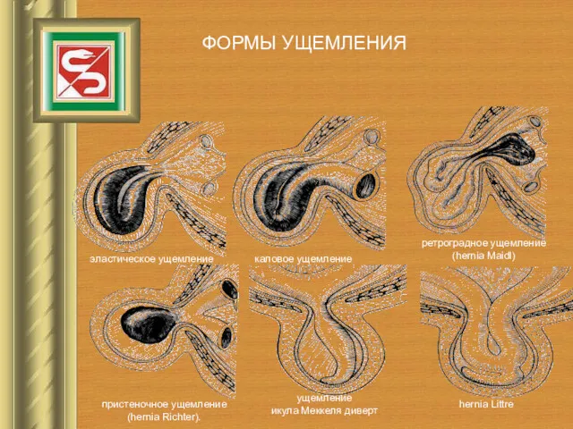 эластическое ущемление ФОРМЫ УЩЕМЛЕНИЯ каловое ущемление ретроградное ущемление (hernia Maidl)