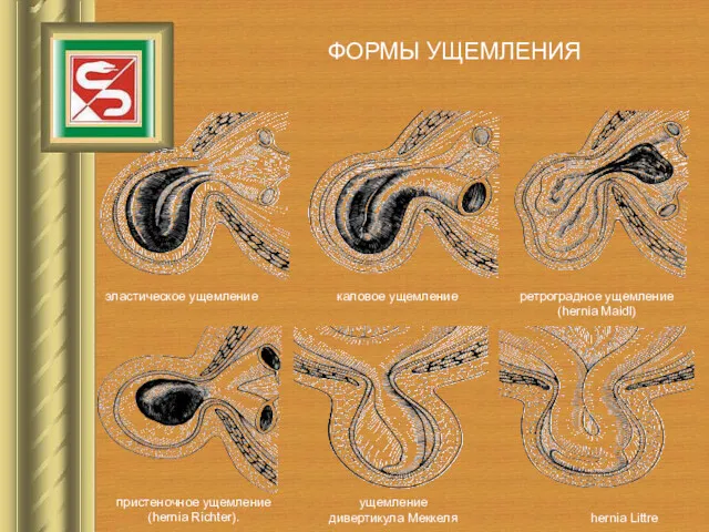 эластическое ущемление ФОРМЫ УЩЕМЛЕНИЯ каловое ущемление ретроградное ущемление (hernia Maidl)