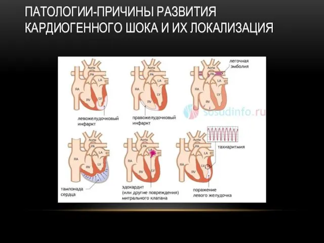 ПАТОЛОГИИ-ПРИЧИНЫ РАЗВИТИЯ КАРДИОГЕННОГО ШОКА И ИХ ЛОКАЛИЗАЦИЯ