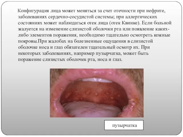 . Конфигурация лица может меняться за счет отечности при нефрите,