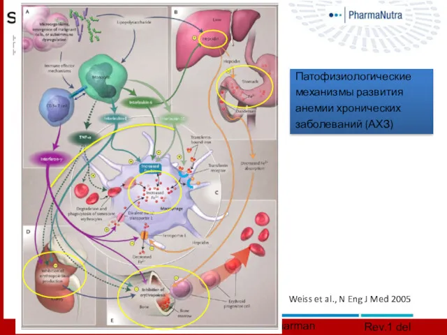 Weiss et al., N Eng J Med 2005 Патофизиологические механизмы развития анемии хронических заболеваний (АХЗ)