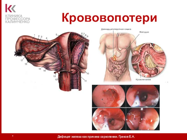 Крововопотери * Дефицит железа как причина саркопении. Греков Е.А.