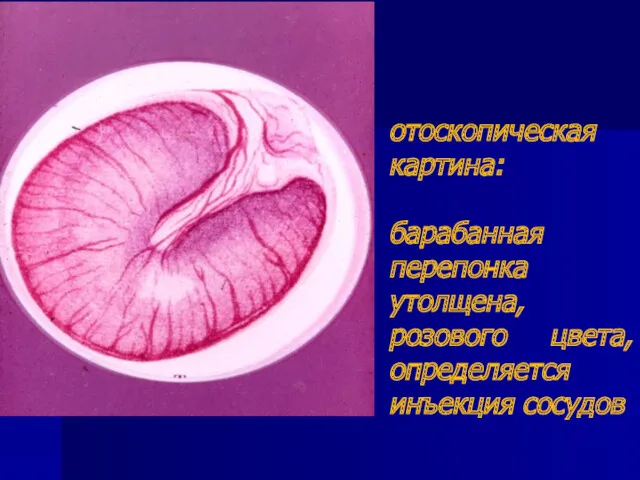 отоскопическая картина: барабанная перепонка утолщена, розового цвета, определяется инъекция сосудов