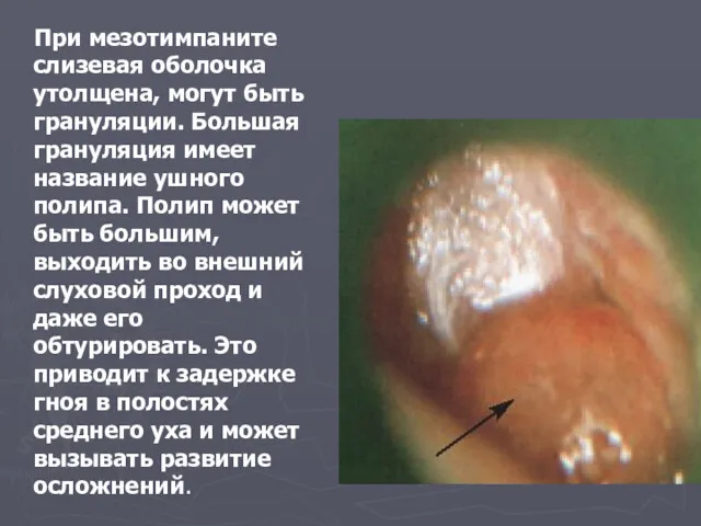 При мезотимпаните слизевая оболочка утолщена, могут быть грануляции. Большая грануляция имеет название ушного