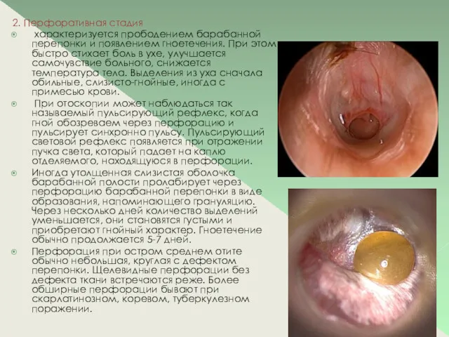 2. Перфоративная стадия характеризуется прободением барабанной перепонки и появлением гноетечения.