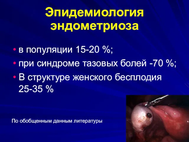 Эпидемиология эндометриоза в популяции 15-20 %; при синдроме тазовых болей