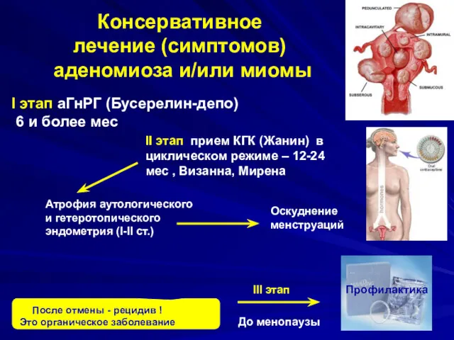 Консервативное лечение (симптомов) аденомиоза и/или миомы I этап аГнРГ (Бусерелин-депо)