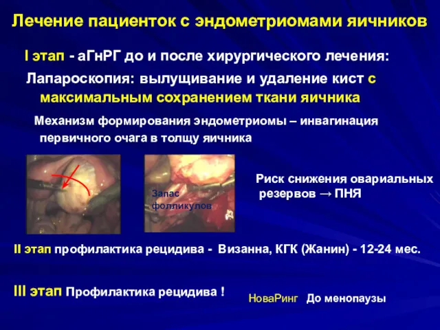 Лечение пациенток с эндометриомами яичников I этап - аГнРГ до