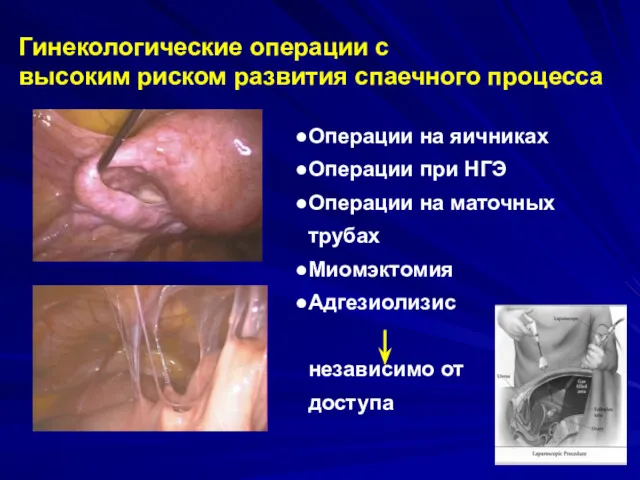 Гинекологические операции с высоким риском развития спаечного процесса Операции на