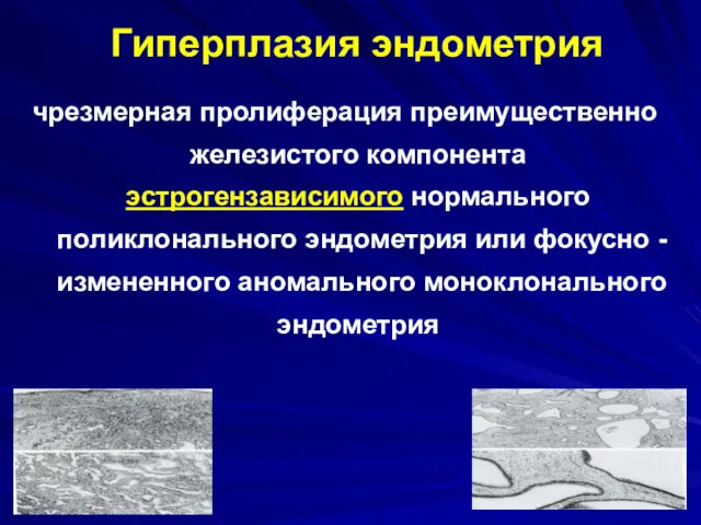 Гиперплазия эндометрия чрезмерная пролиферация преимущественно железистого компонента эстрогензависимого нормального поликлонального