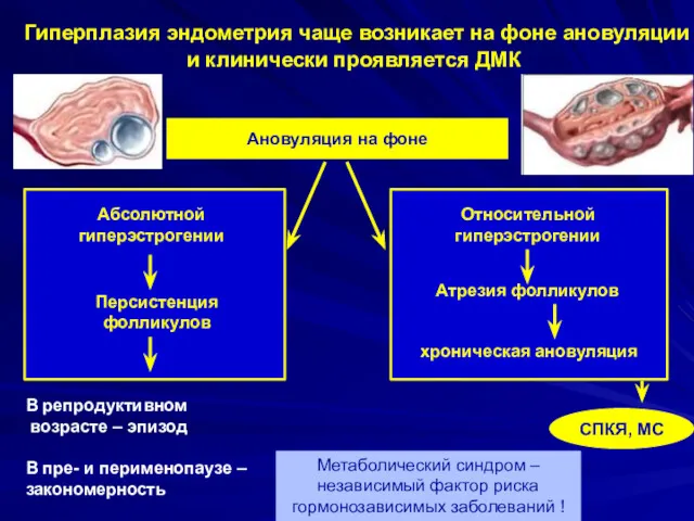 СПКЯ, МС Ановуляция на фоне Гиперплазия эндометрия чаще возникает на