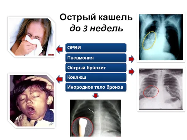 Острый кашель до 3 недель