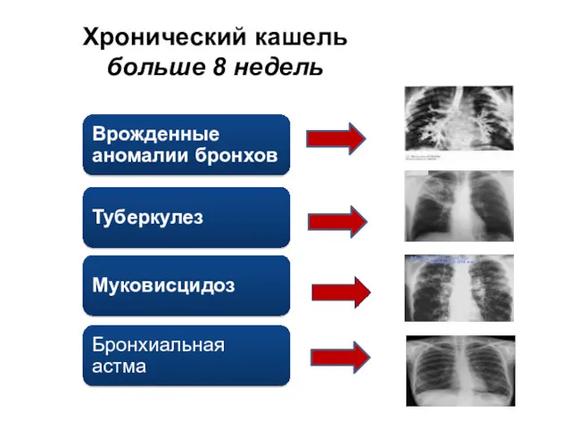 Хронический кашель больше 8 недель