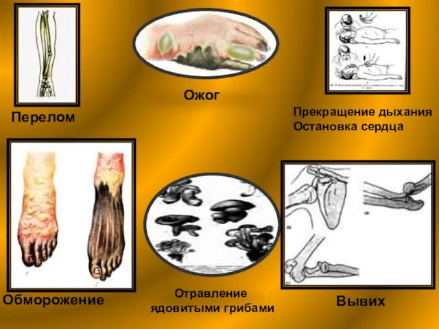 Перелом Ожог Прекращение дыхания Остановка сердца Обморожение Отравление ядовитыми грибами Вывих