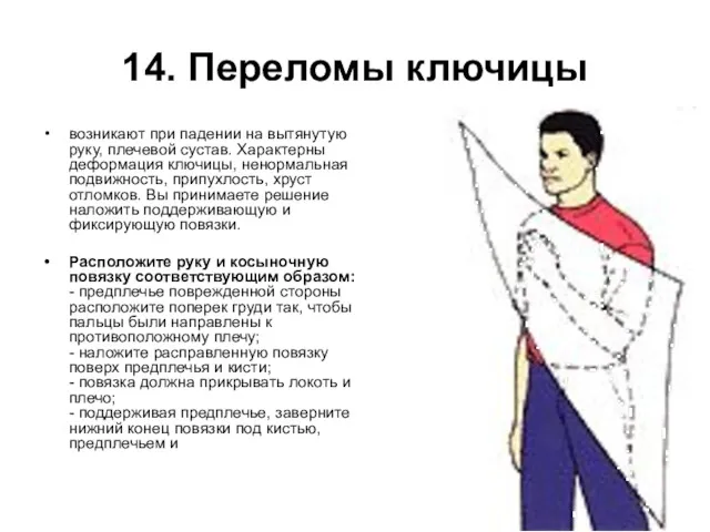 14. Переломы ключицы возникают при падении на вытянутую руку, плечевой