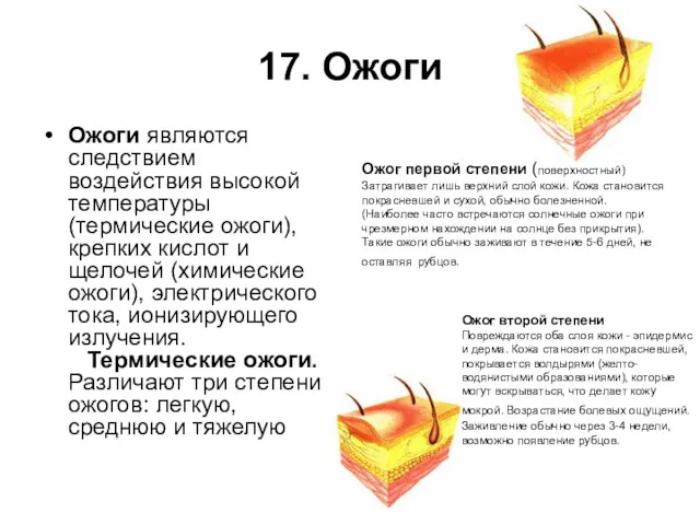 17. Ожоги Ожоги являются следствием воздействия высокой температуры (термические ожоги),