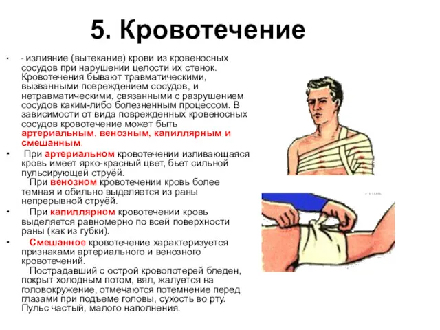 5. Кровотечение - излияние (вытекание) крови из кровеносных сосудов при