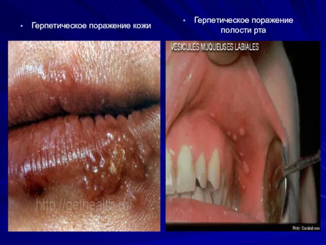 Герпетическое поражение кожи Герпетическое поражение полости рта