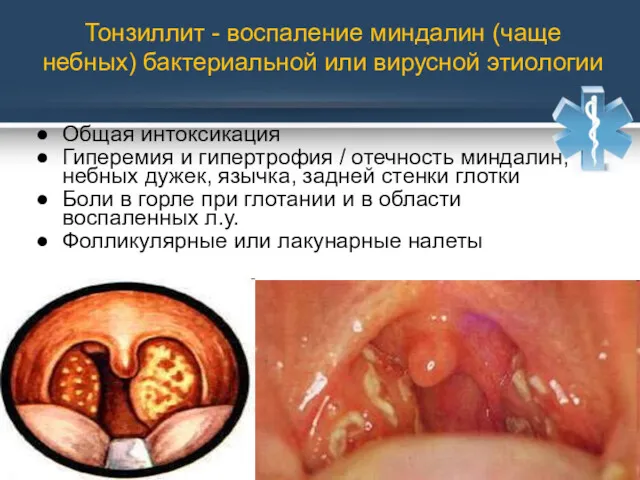 Тонзиллит - воспаление миндалин (чаще небных) бактериальной или вирусной этиологии Общая интоксикация Гиперемия