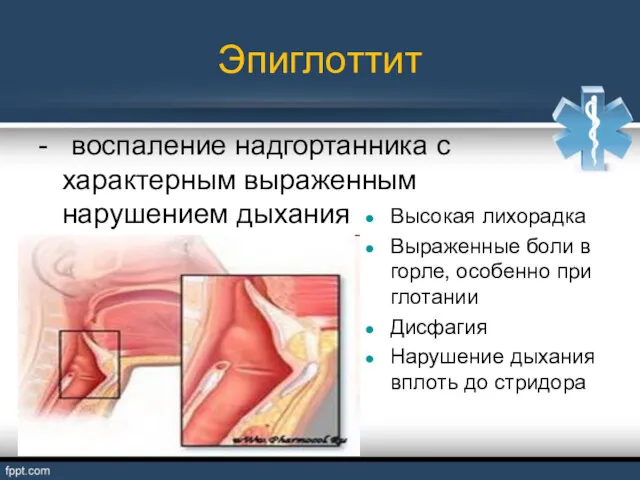 Эпиглоттит - воспаление надгортанника с характерным выраженным нарушением дыхания Высокая лихорадка Выраженные боли