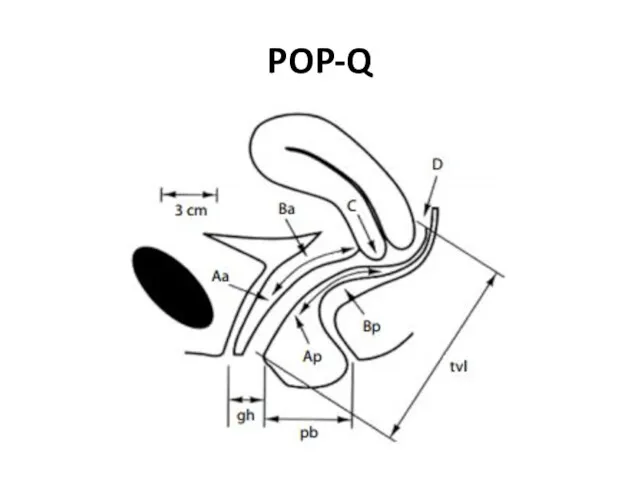 POP-Q