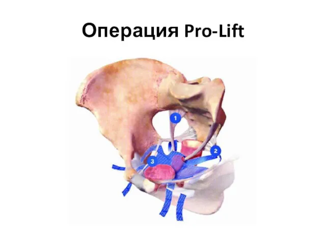 Операция Pro-Lift